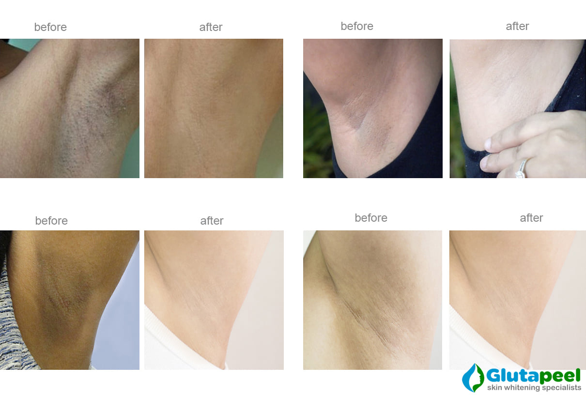 Long Lasting Results! Package result of Intensive Underarm Whitening. In this treatment, the underarms are given a sponge bath and then buffed with a glutathione scrub. This prepares them for the peel