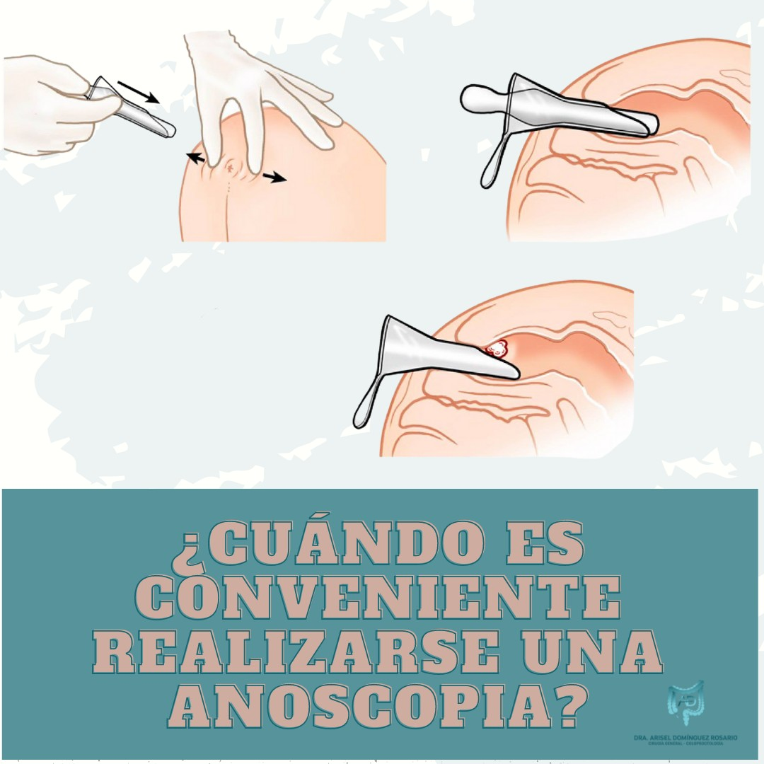 La anoscopia se realiza... - Dra. Arisel Domínguez Rosario