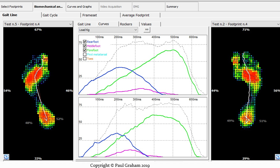 Brent's forefoot pain (case study)... - Step Force Training
