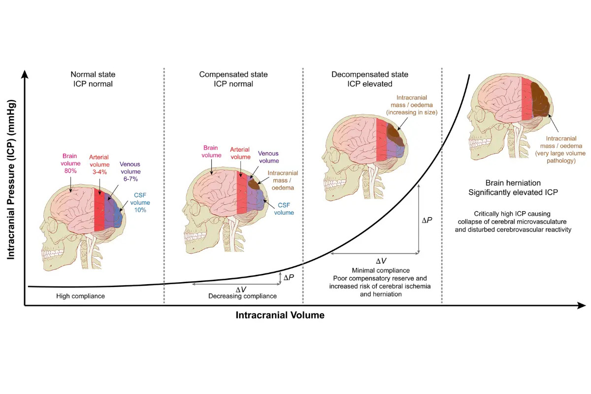 🧠 เข้าใจหลักคำสอน Monro-Kellie... - นิวโรศัลย์ E4 V5 M6 | Facebook