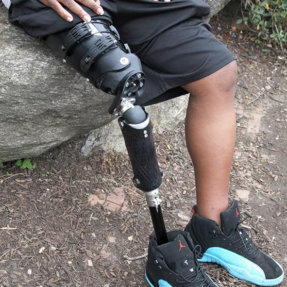 Allard USA - The iFIT Transfemoral Prosthesis is now available through ...