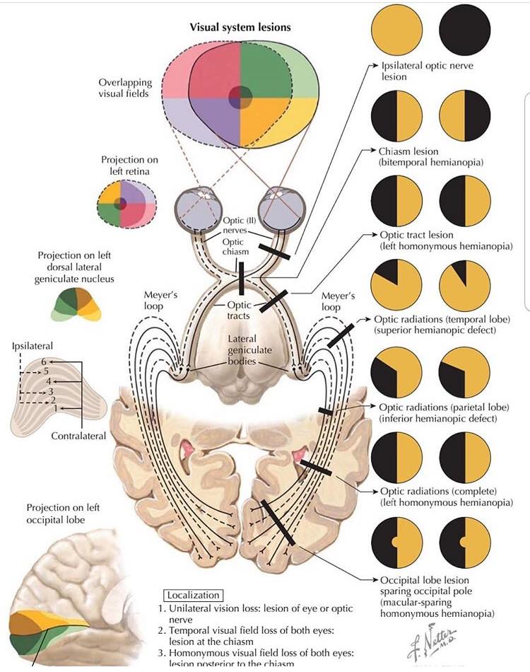Visual System Lesions:... - Ophthalmology-Notes And Synopses | Facebook