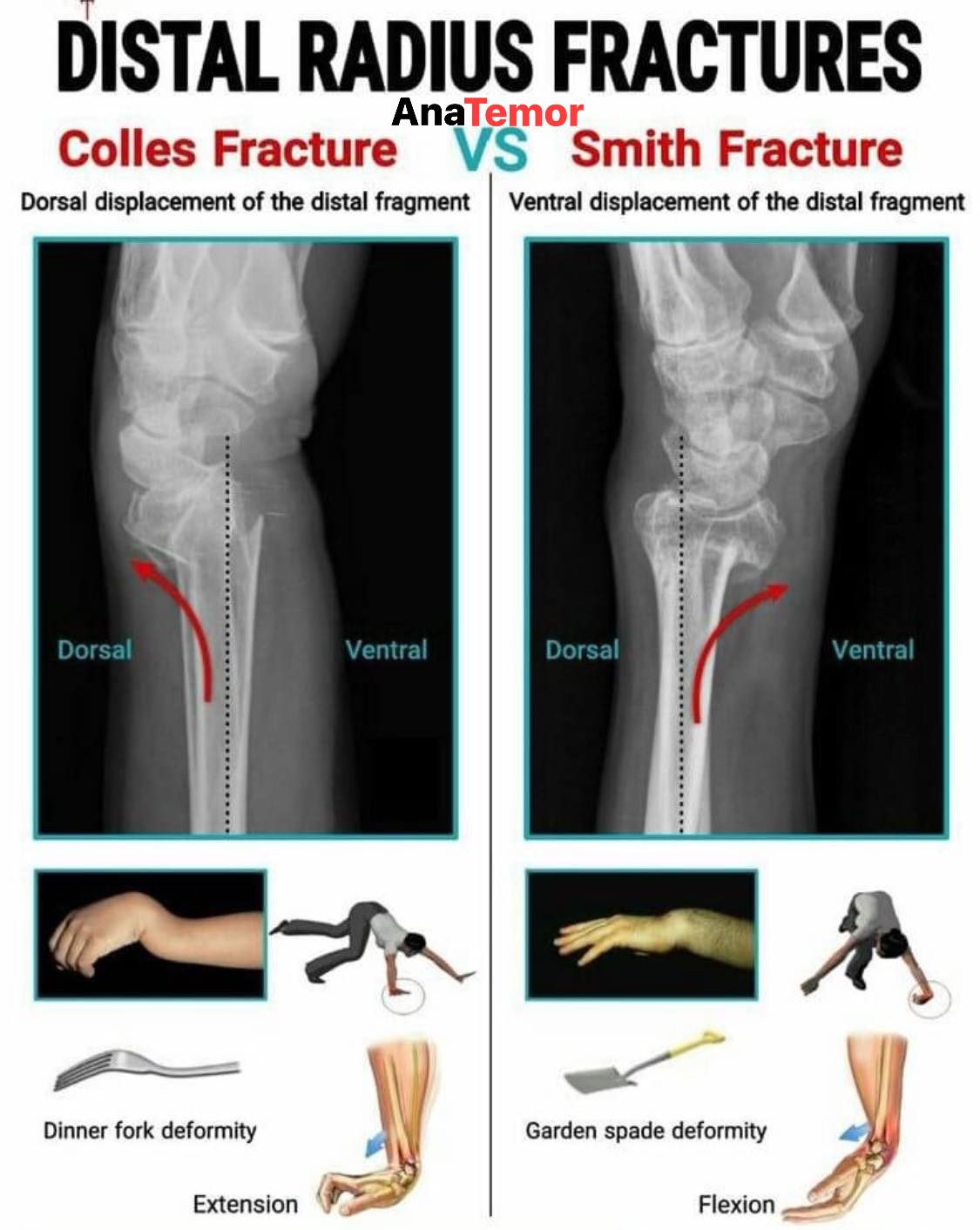 AnaTemor - ‼️⭕️👉🏼Colles vs. Smith Fracture | Facebook
