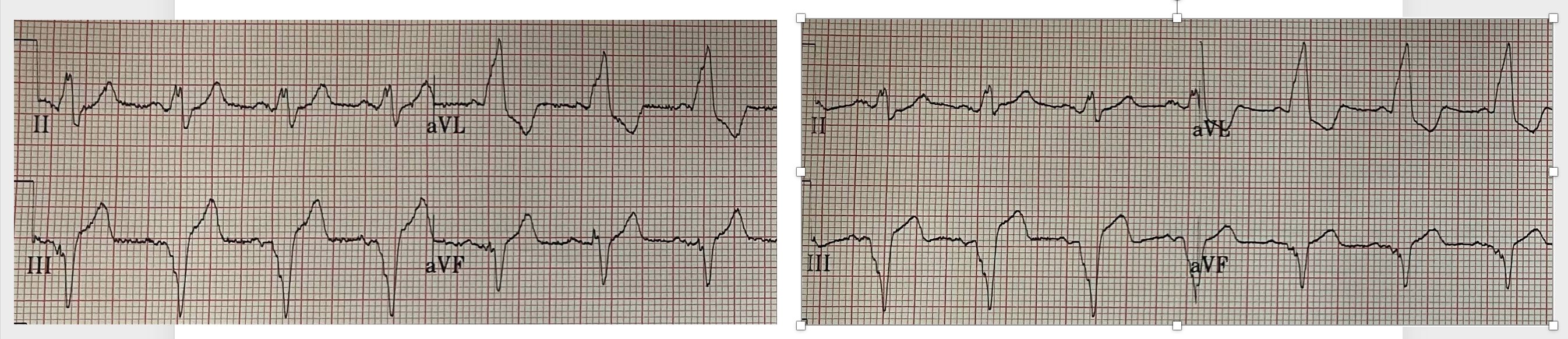 Subtle ECG Signs of OMI in LBBB.... - Dr. Smith's ECG Blog | Facebook