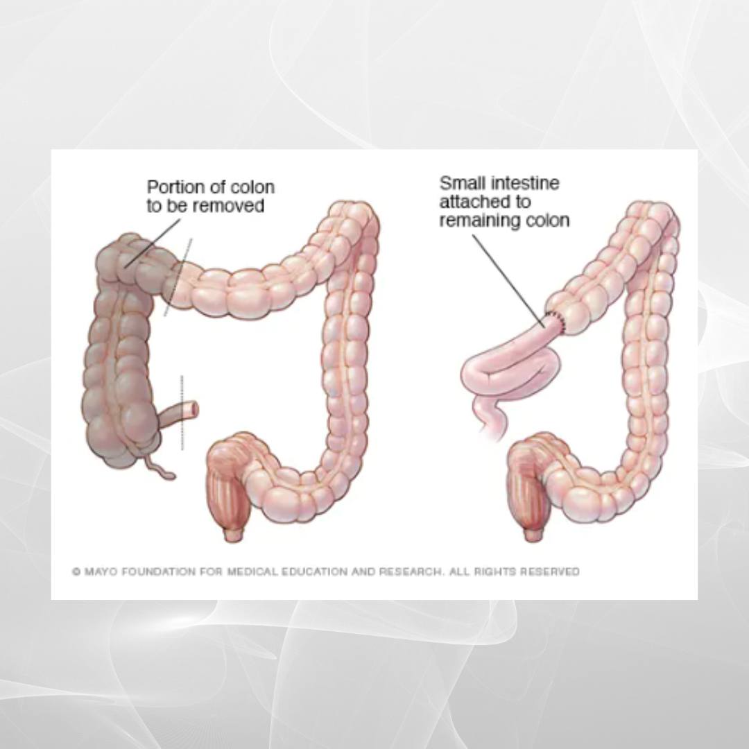 #Hemicolectomy #Why is Hemicolectomy Needed? Hemicolectomy is a # ...