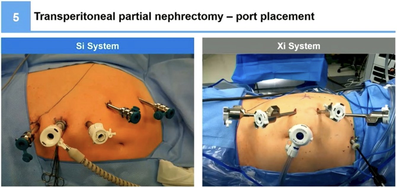 UroToday - Robotic transperitoneal and retroperitoneal... | Facebook