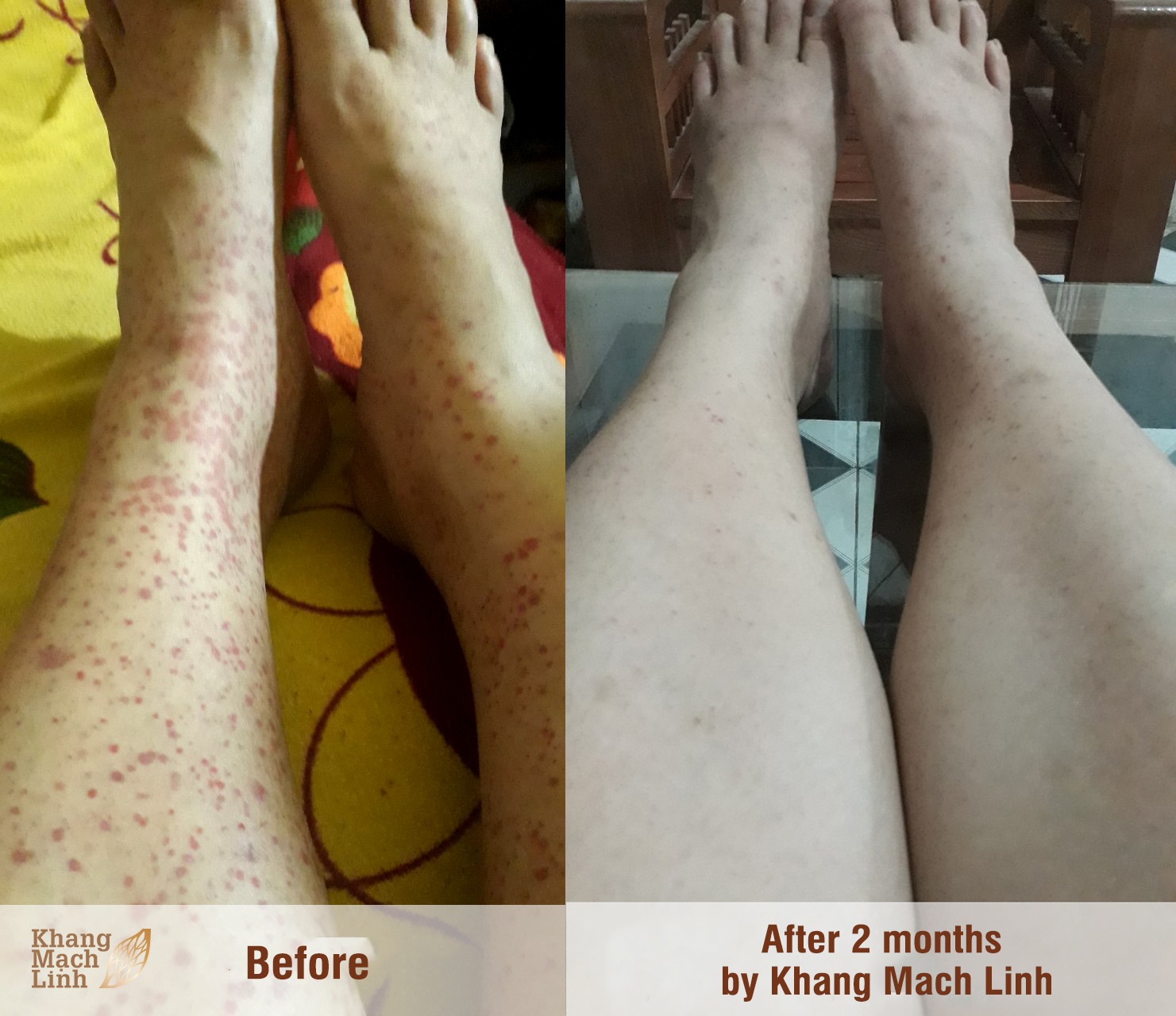Henoch-Schonlein - Ms. Linh (name of the patient changed), 28 years old ...