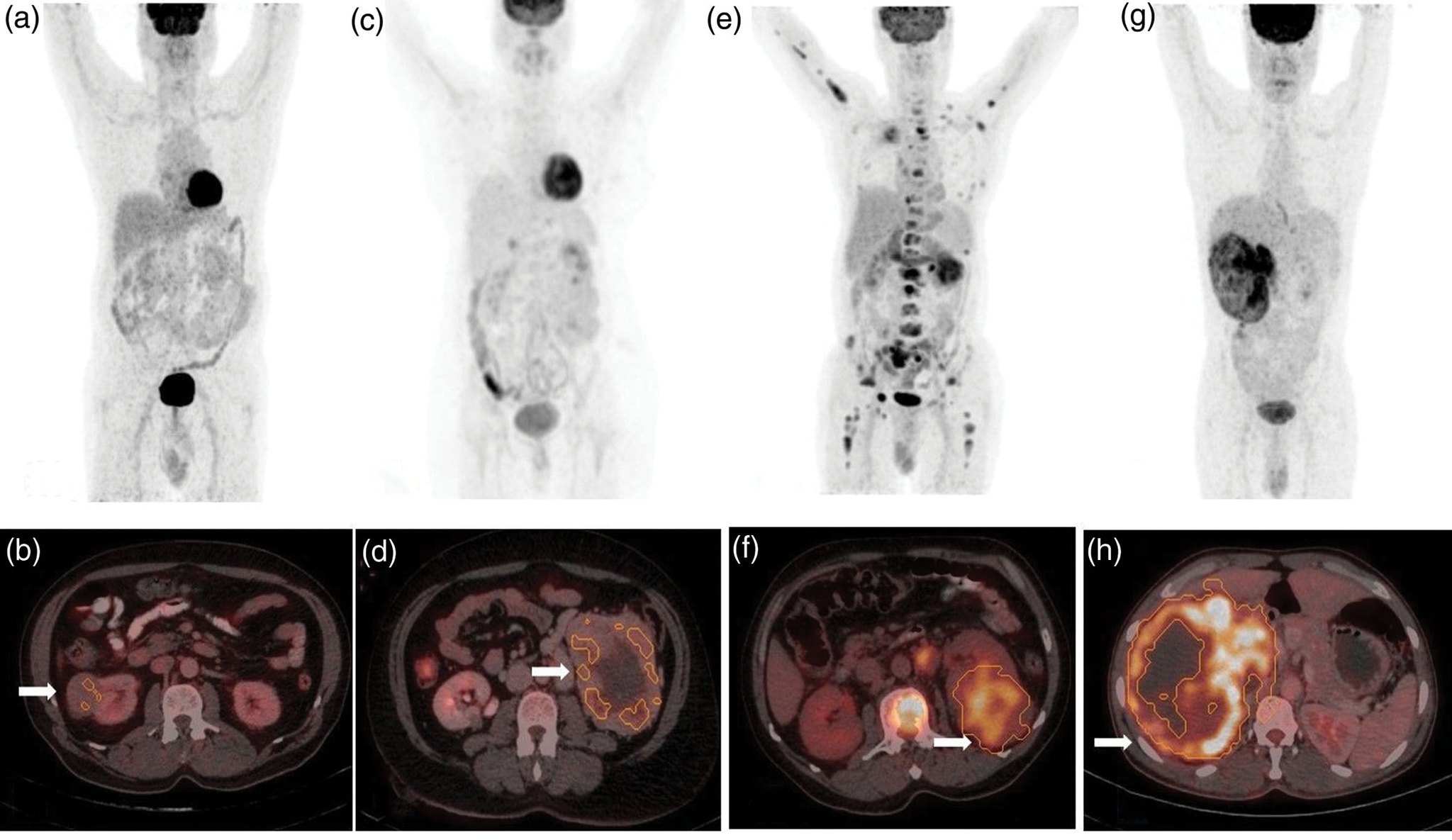 Nuclear - Can 18F FDG PET/CT metabolic parameters be used to ...