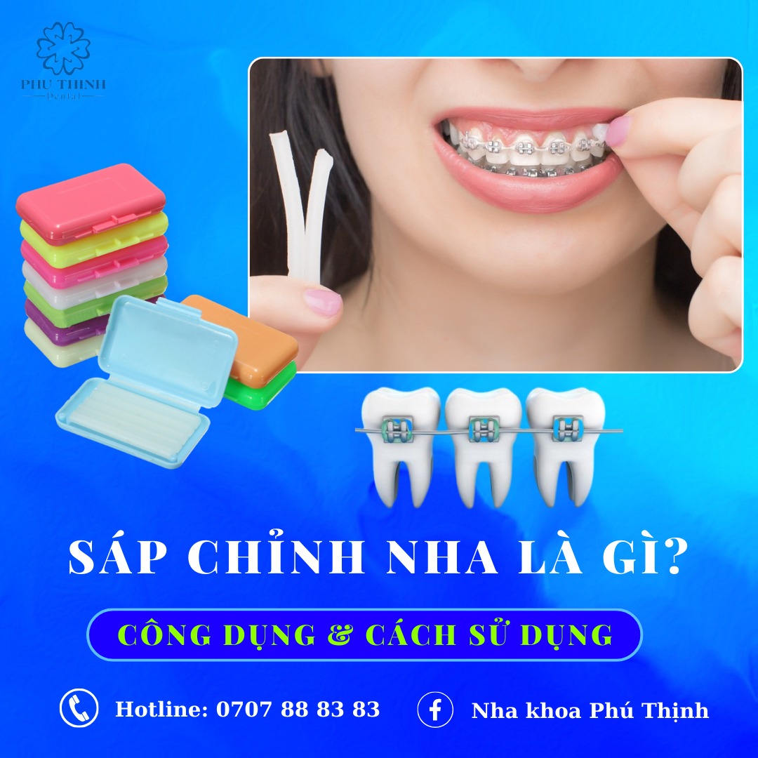 Nha - 💢 𝐍𝐇𝐔̛̃𝐍𝐆 Đ𝐈𝐄̂̀𝐔 𝐂𝐀̂̀𝐍 𝐁𝐈𝐄̂́𝐓 𝐕𝐄̂̀ 𝐒𝐀́𝐏 𝐂𝐇𝐈̉𝐍𝐇 𝐍𝐇𝐀 Sáp chỉnh nha ...