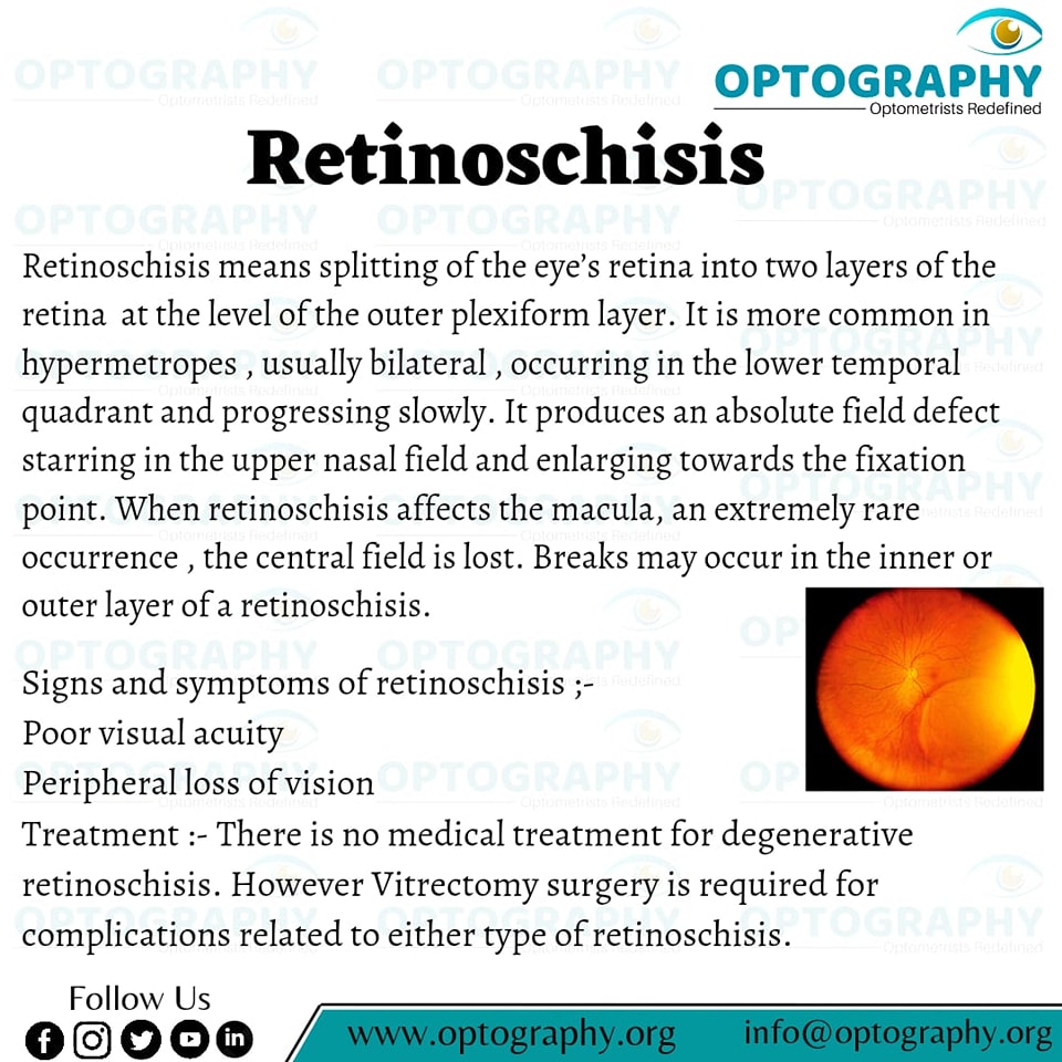 Optography - Retinoschisis means splitting of the eye's... | Facebook