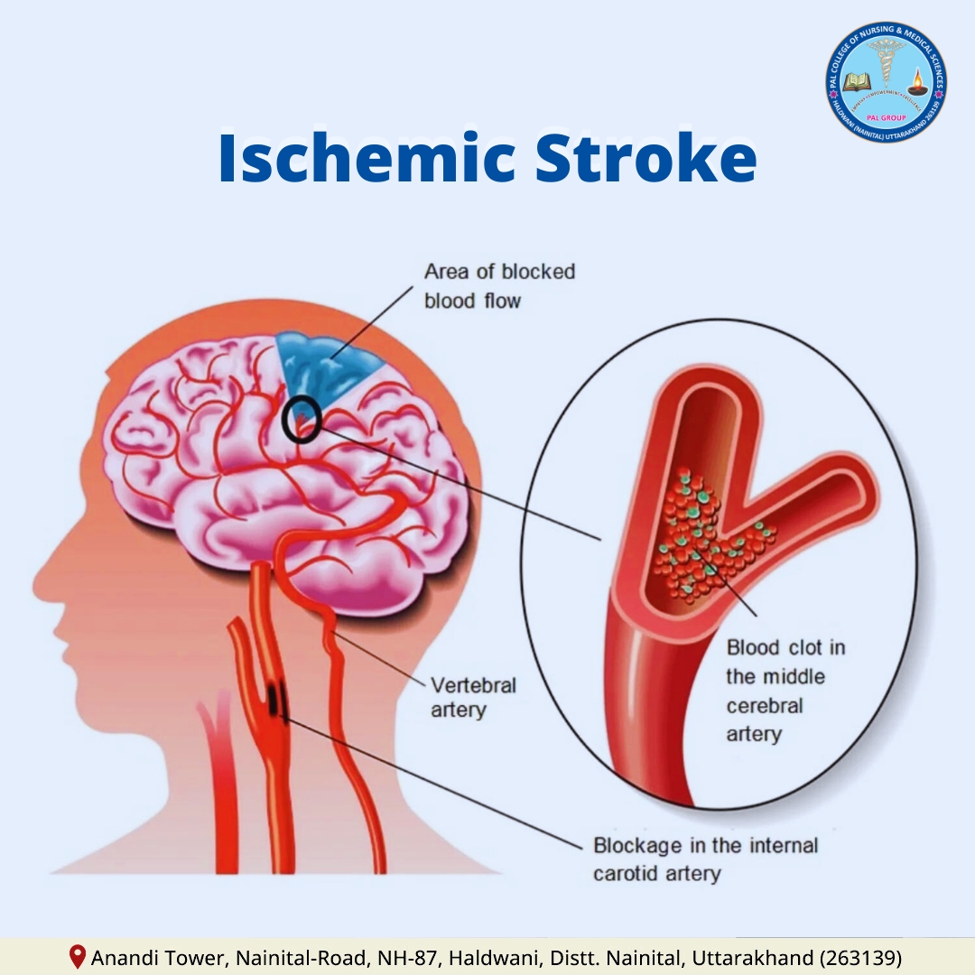 Pal - Understanding ischemic stroke made easy! 🧠 This diagram shows how ...
