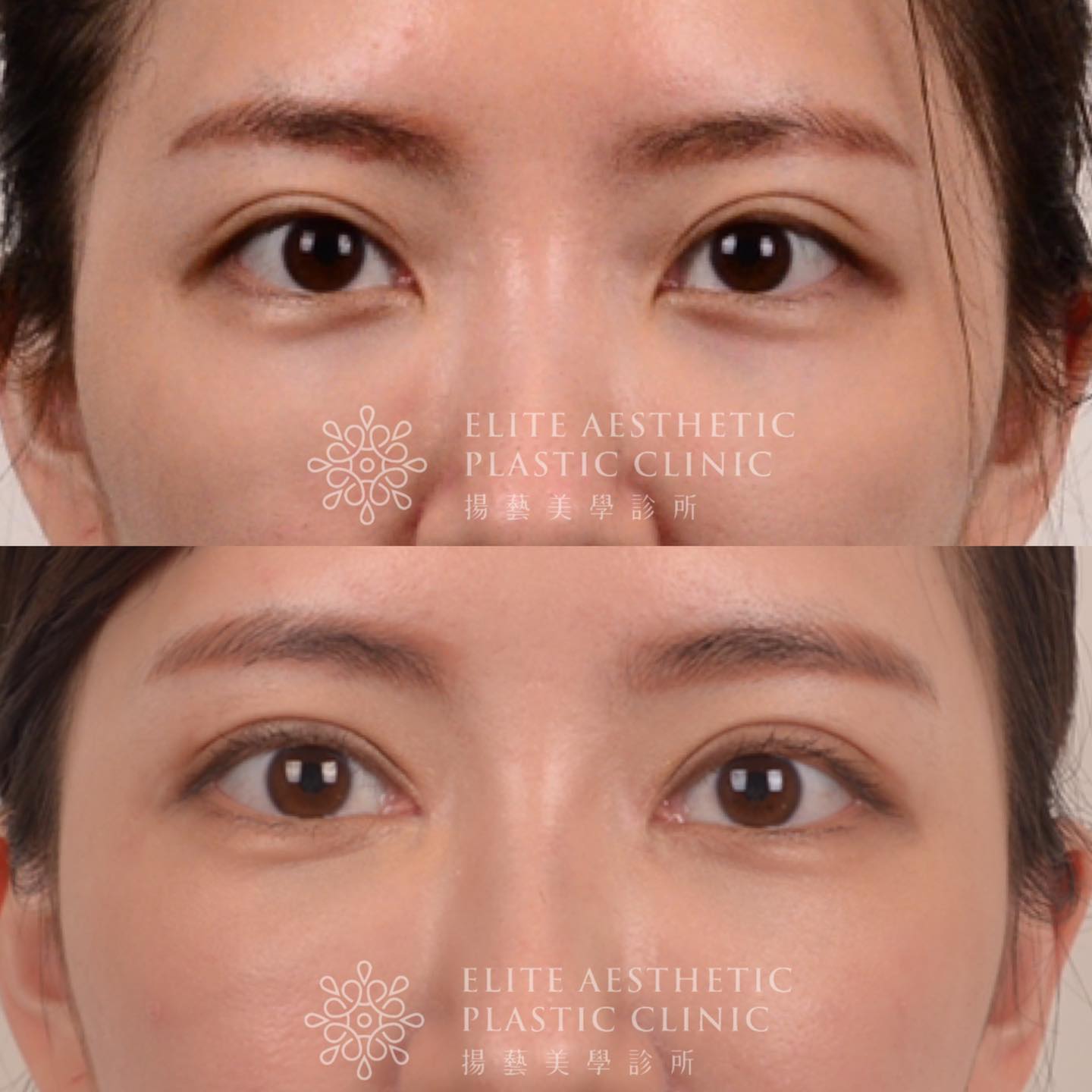 賴慶鴻 - 眼形升級手術 #CPR Contour and Palpebral Reconstruction 這個概念 最初是由大陸王振軍醫師 ...