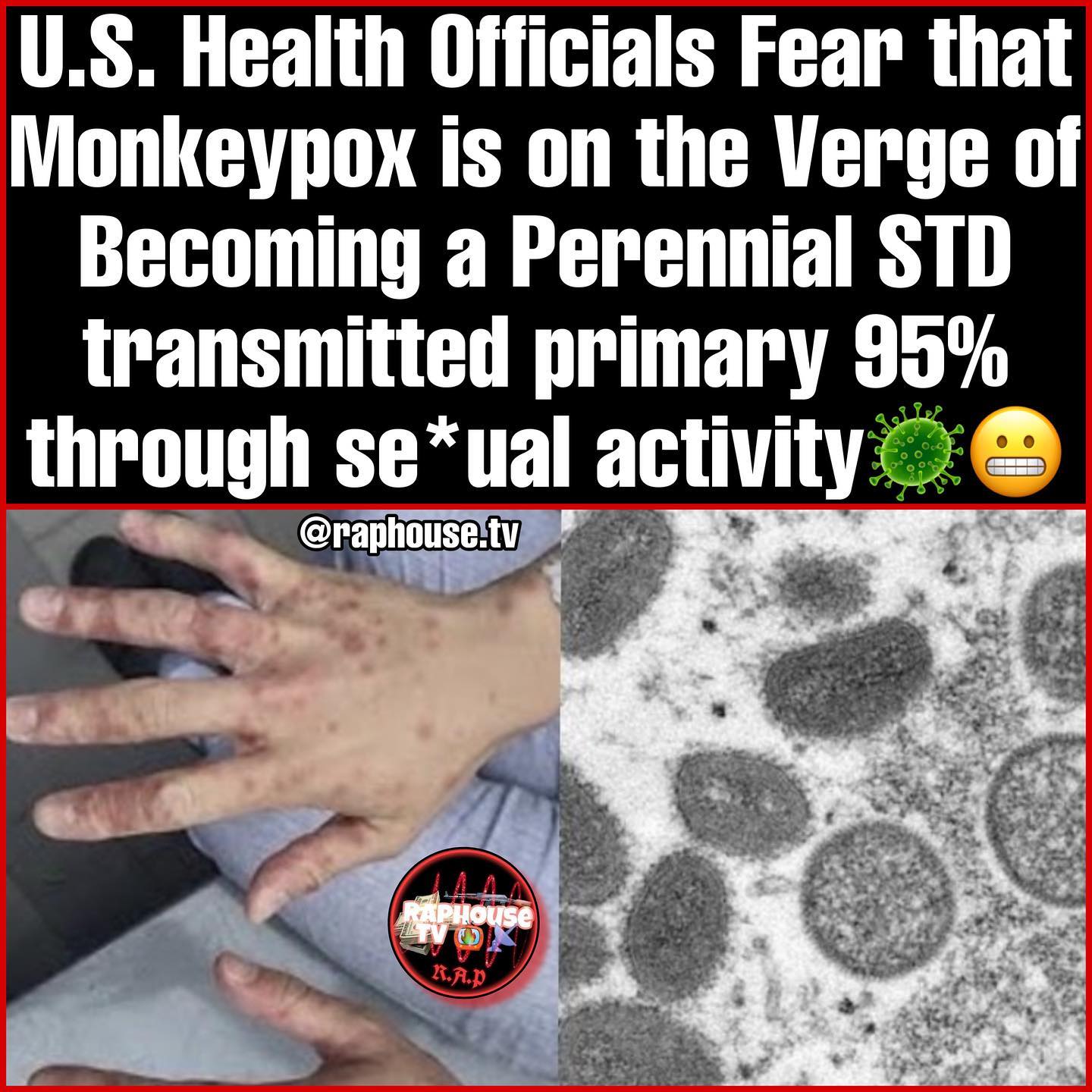 Raphouse TV - A new study has shown 95% of monkeypox cases... | Facebook