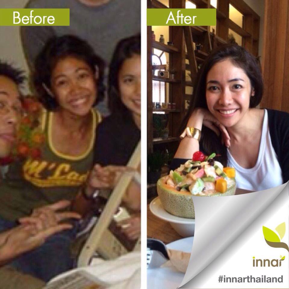Inna... - Innar Thailand จบทุกสภาพผิว ที่ดาราชั้นนำกล้าการันตี | Facebook