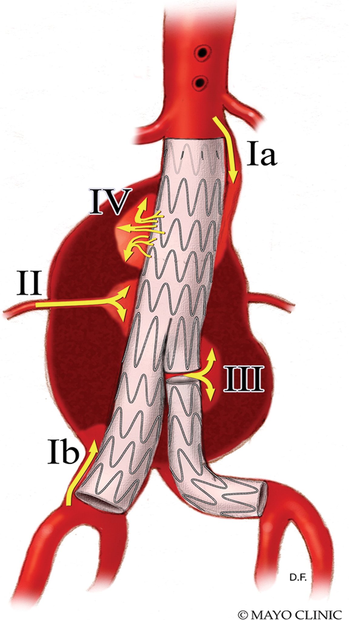 RadioGraphics - Endoleak is a common complication after... | Facebook