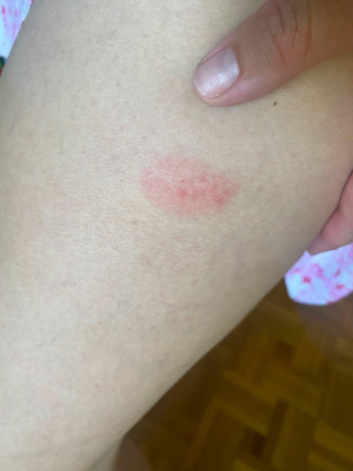 GLP1 injection site swelling and itching?
