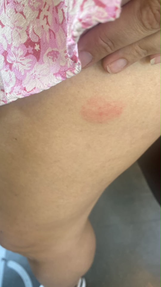GLP1 injection site swelling and itching?