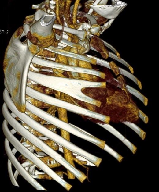 Bifid or forked ribs are uncommon.... - Radiology Warriors | Facebook