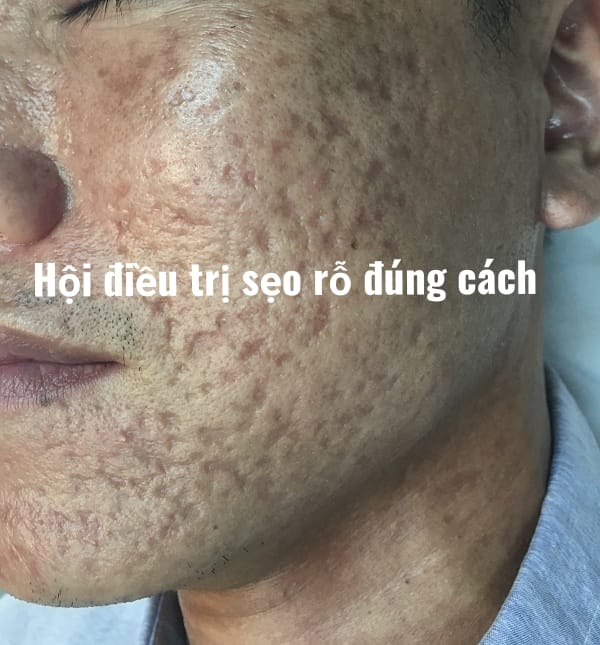 Hội điều trị sẹo rỗ đúng cách | Facebook