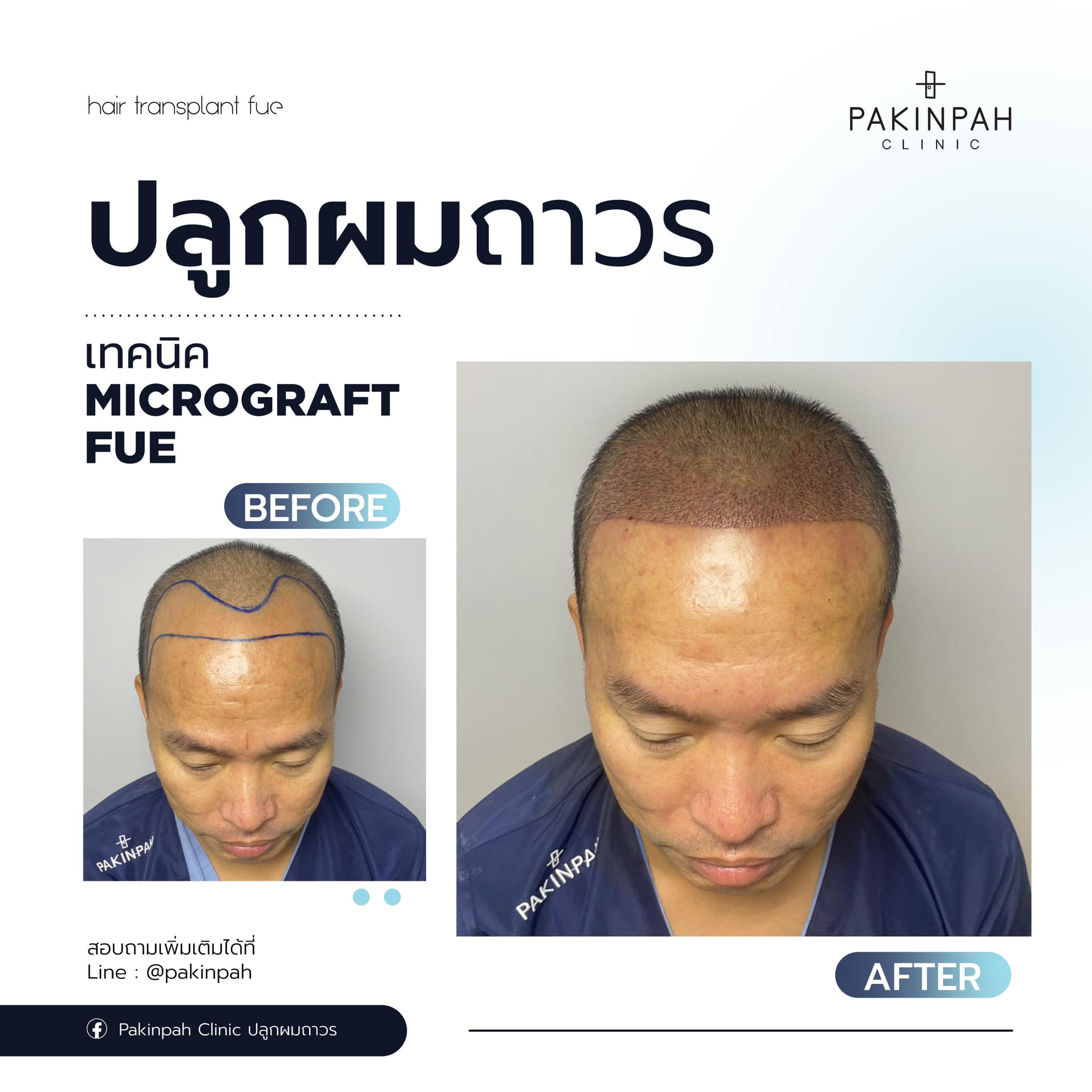 ปลูกผม Micrograft FUE... - Pakinpah Clinic ปลูกผมถาวร | Facebook