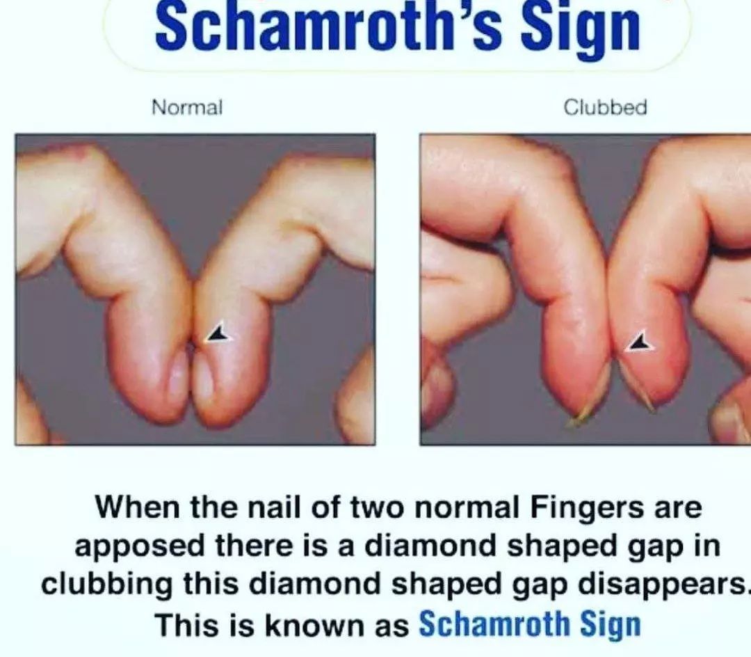 Nursing News - New nail clubbing with positive Schamroth...