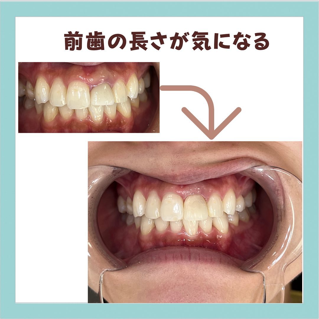 英 歯科 - 前歯の長さが気になる貴方 ️ 隣の歯より被せ物が短い、 歯茎の位置が気になると、来院されまさた。... | Facebook