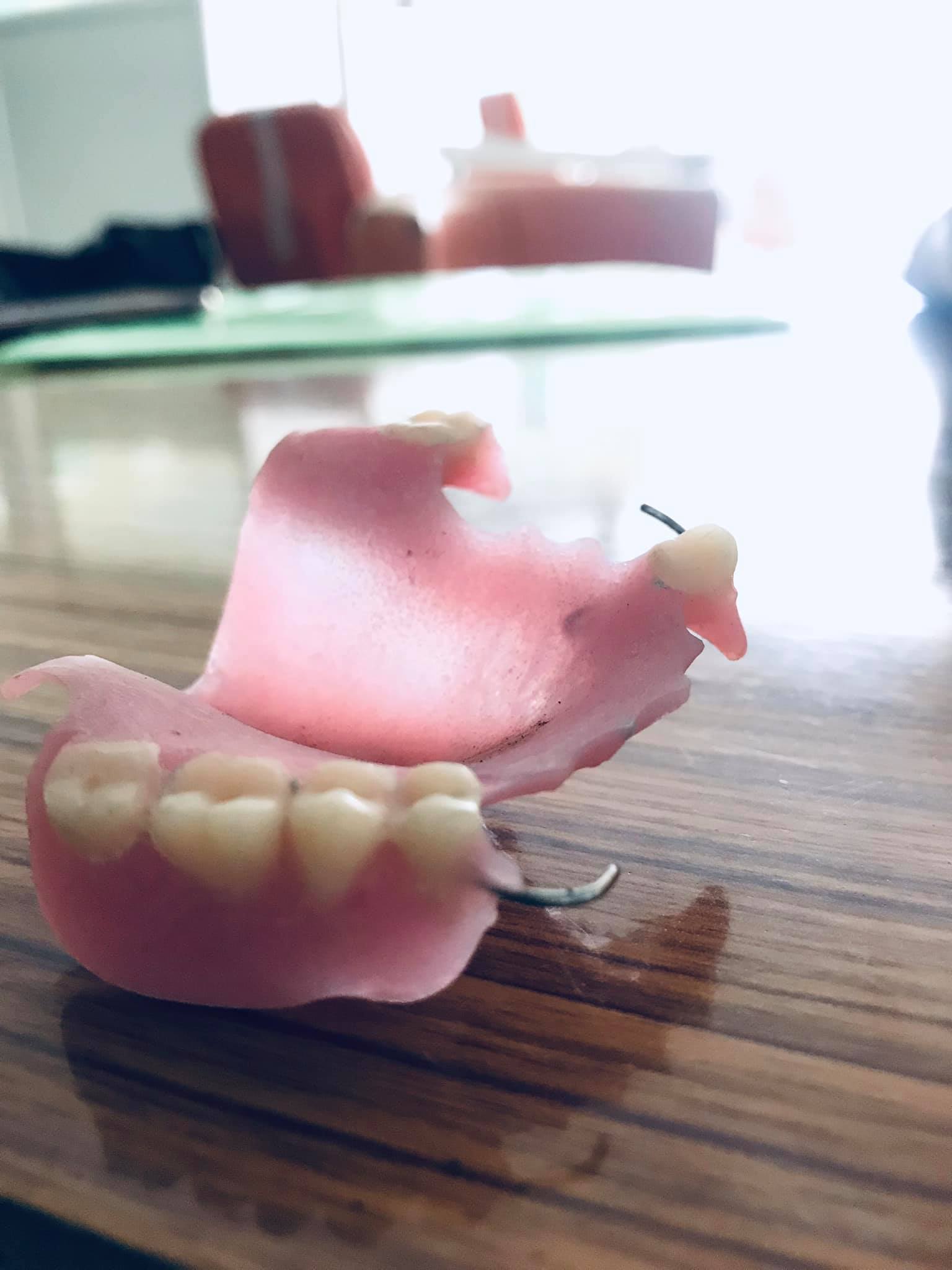 32Crowns - A removable partial denture (RPD) is a denture for a ...