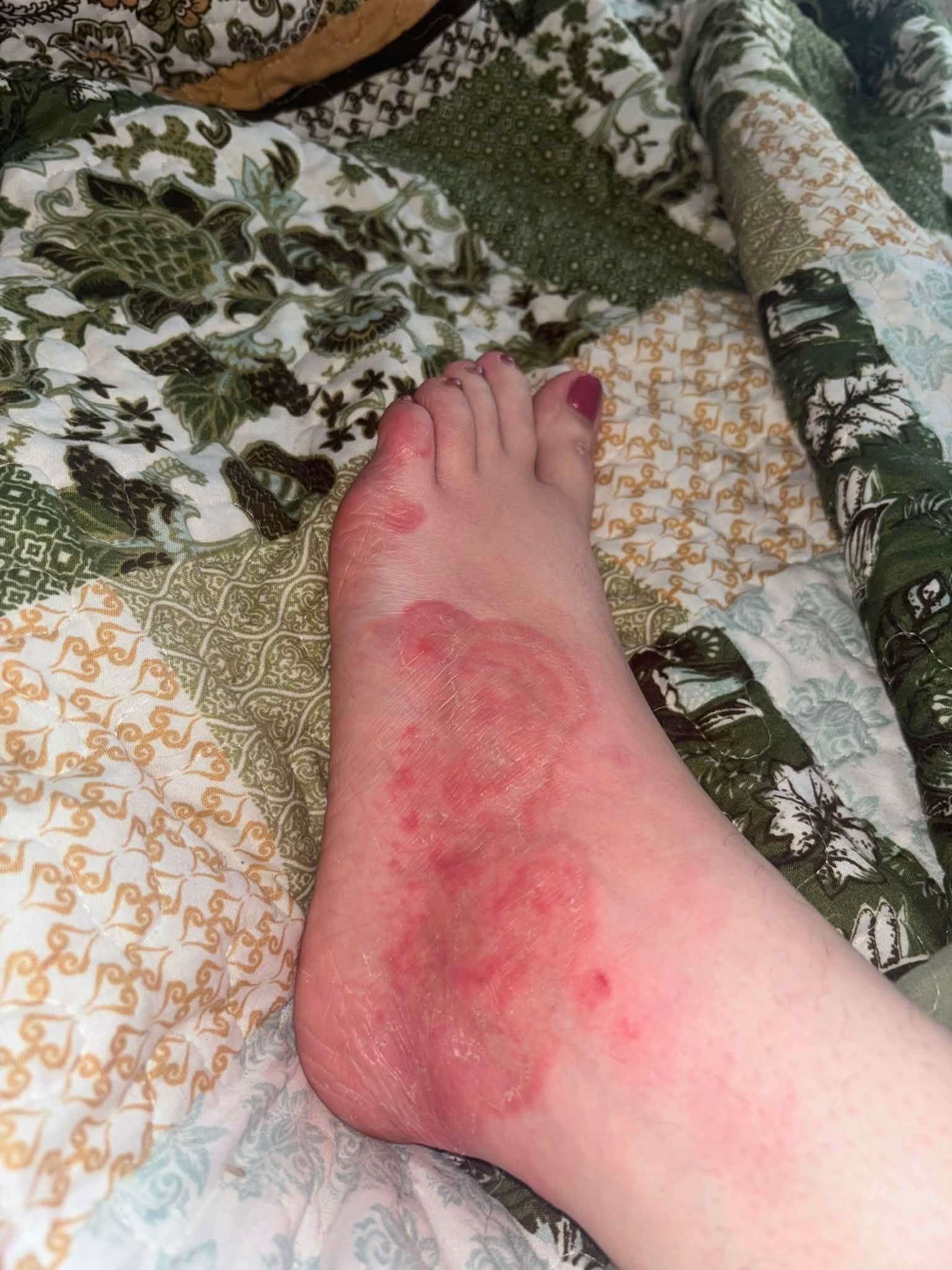 rash tirzepatide BPI labs breaking me out in acne rash!! : r/tirzepatidecompound Does Tirzepatide Cause Skin Sensitivity?