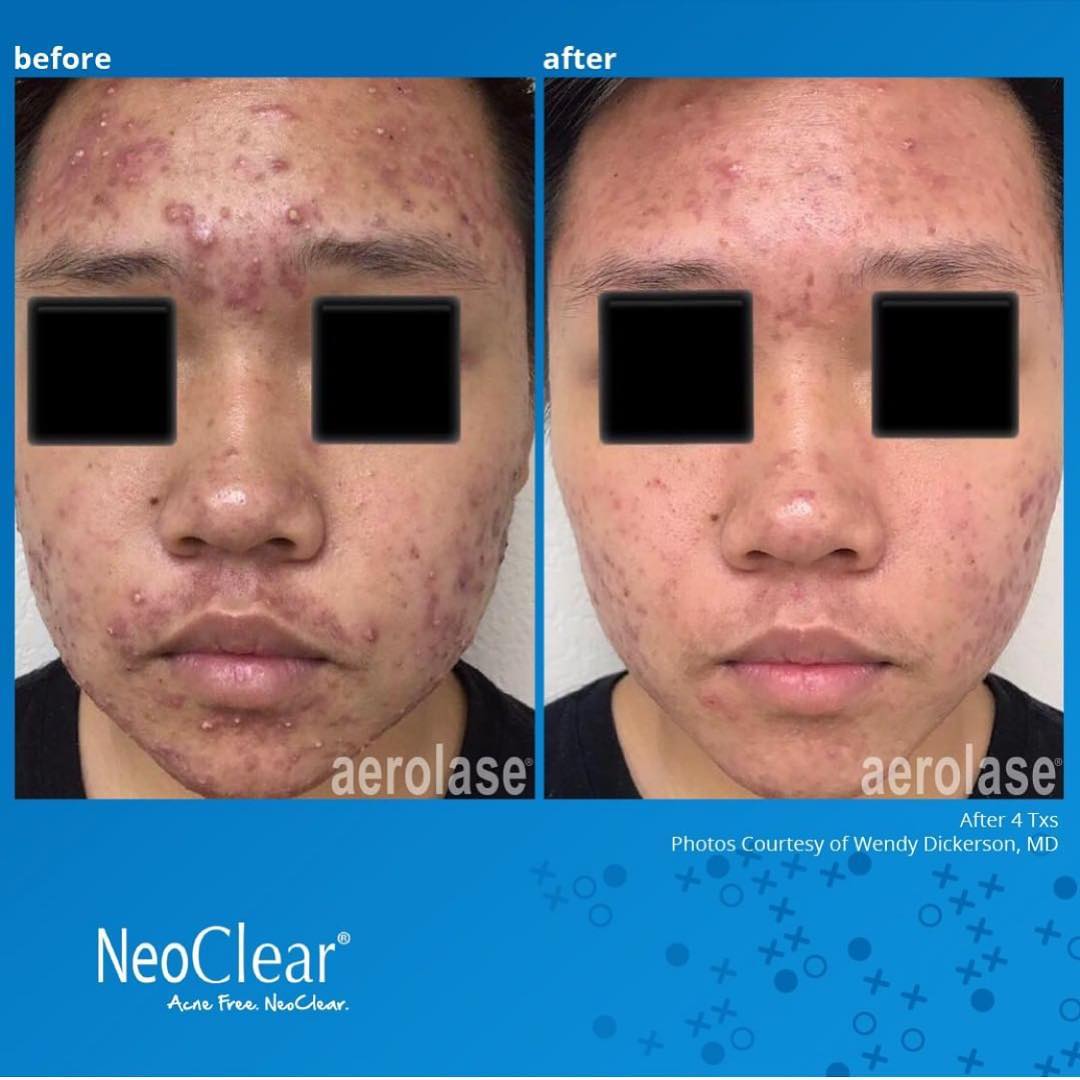 NeoClear by Aerolase
