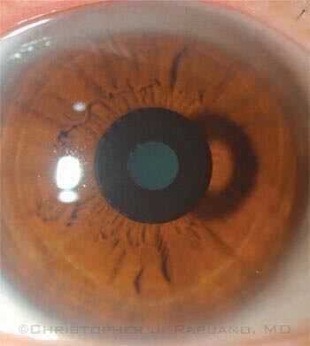 ️ KAMRA Corneal Inlay:... - Ophthalmology-Notes And Synopses | Facebook
