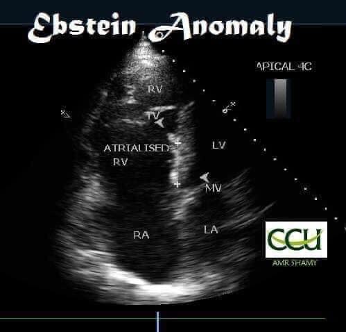 CCU - 🙇What is Ebstein’s Anomaly⁉️ #CCU_ANOMALY...