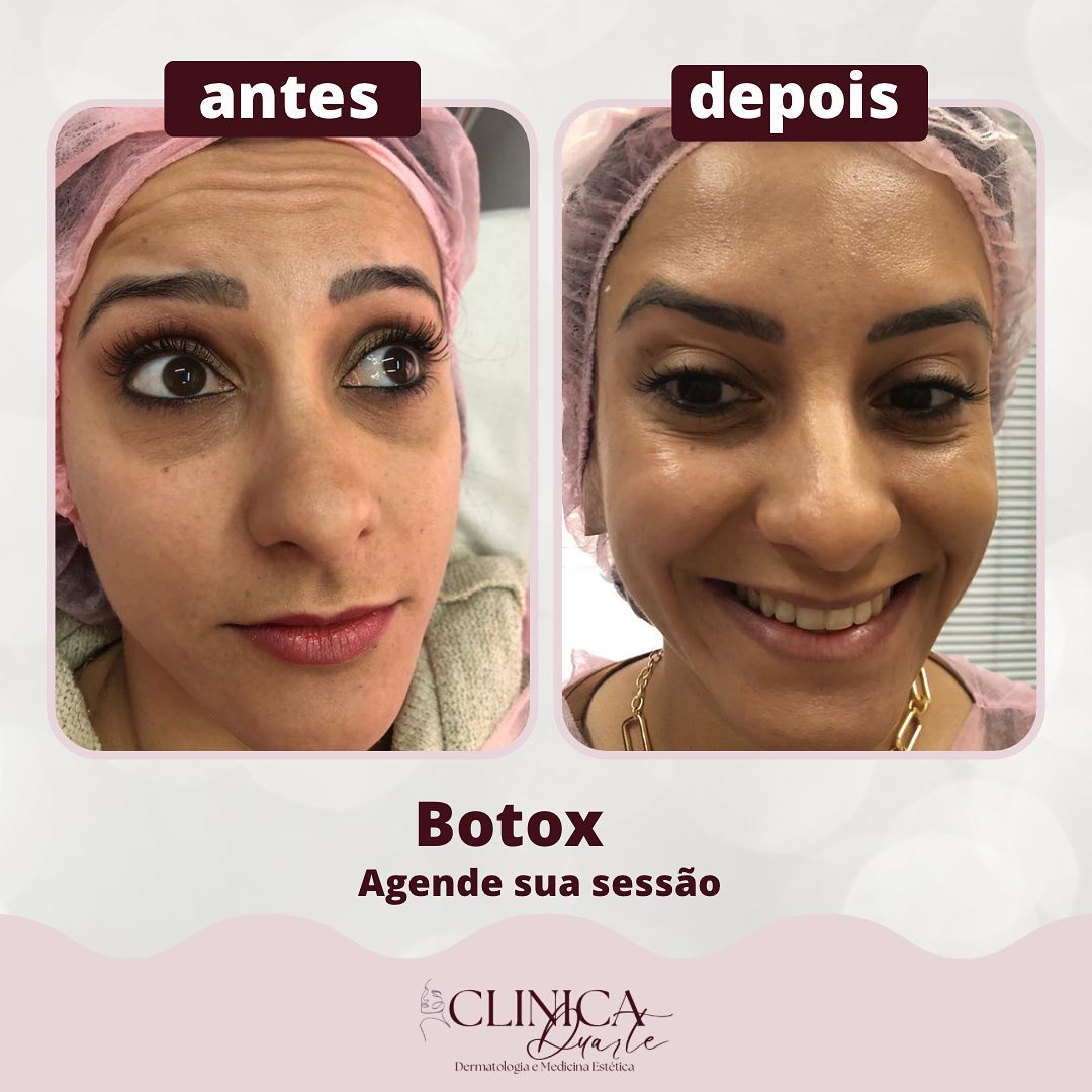 Clínica Duarte - Botox Antes e depois de sucesso 💗...