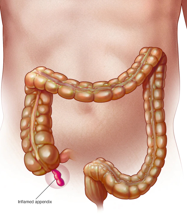 Acute Appendicitis Appendicitis is inflammation of the appendix, a ...