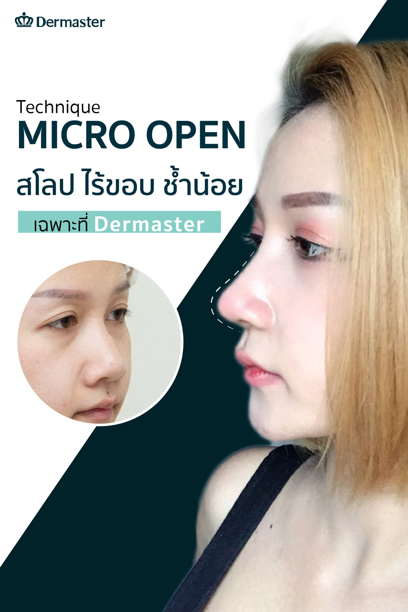 Dermaster - 👉🏻เสริมจมูกเทคนิค Micro Open เเผลเล็ก เจ็บน้อบ... | Facebook