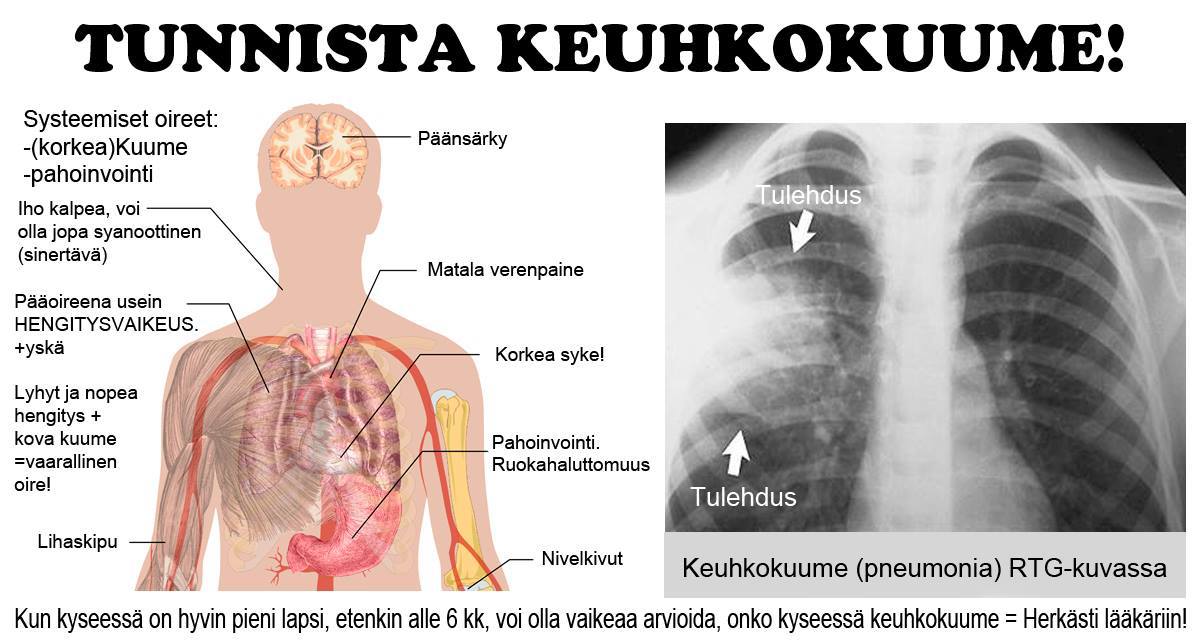 ensiapu-pyyd-mme-ett-jaat-t-m-n-facebookissa-asiaa-keuhkokuumeesta