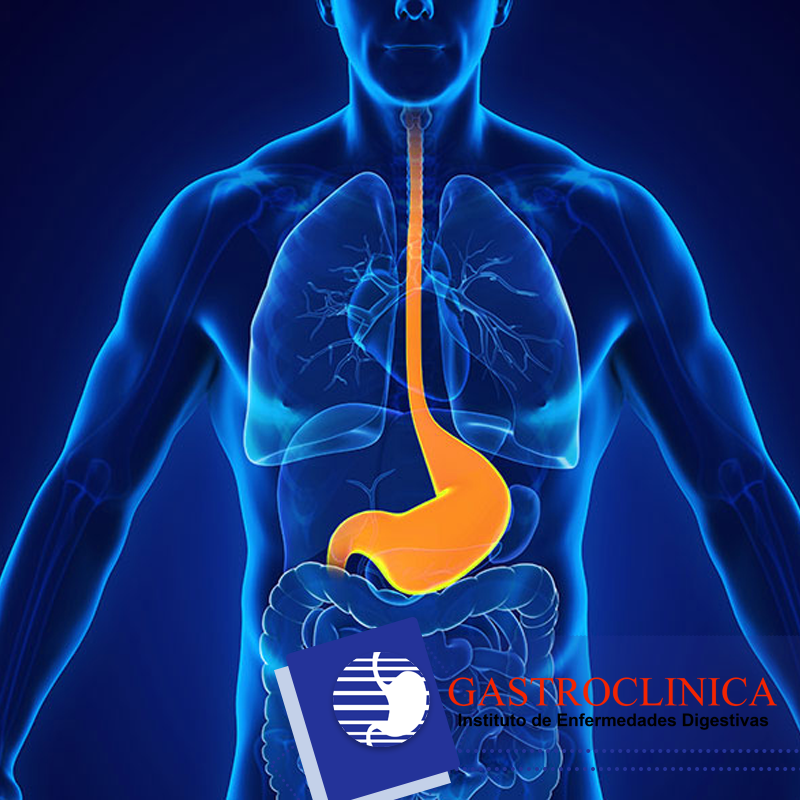 Gastroclinica - Esofagitis La esofagitis es una inflamación que puede ...