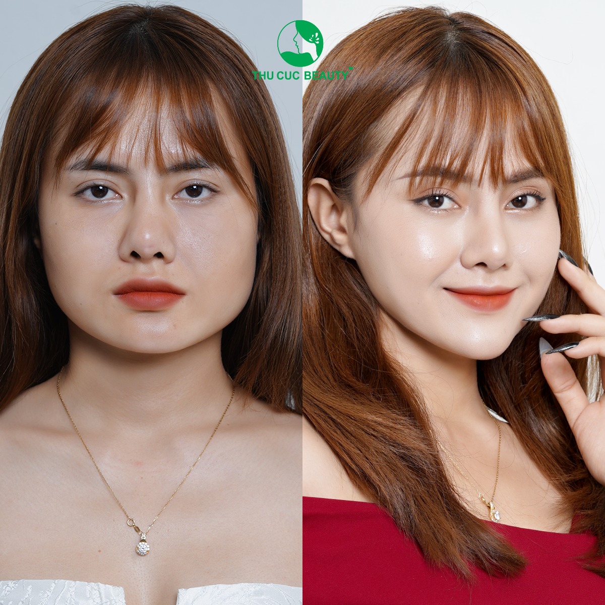 Bệnh Viện Thẩm Mỹ Thu Cúc - FILLER 4D - BÍ QUYẾT XINH ĐẸP CHỈ ~15P THỰC ...
