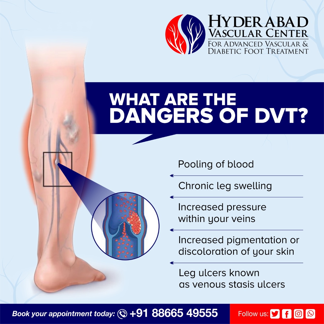 Hyderabad - The Dangers Of DVT : Don't Ignore These Signs 👉Pooling of ...