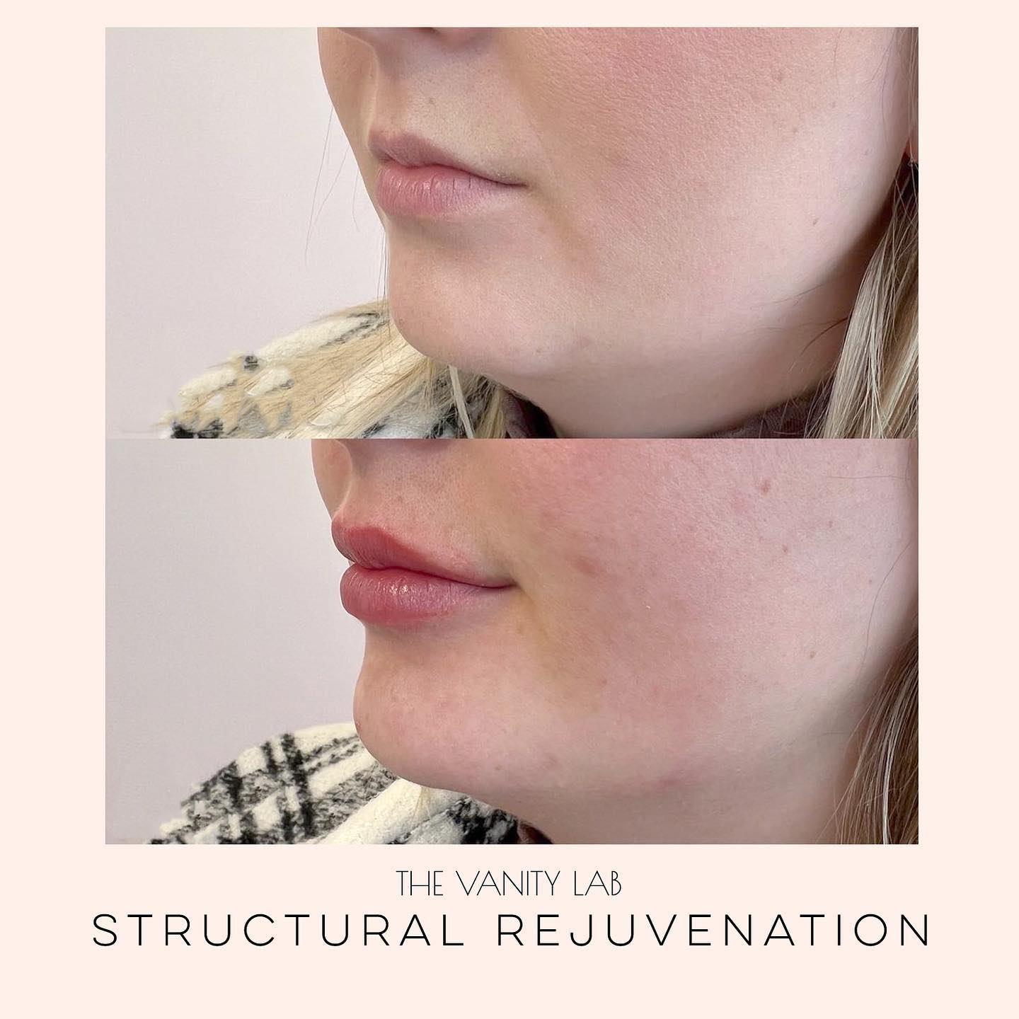 The Vanity Lab - 💉 Before and after: lower face refresh...