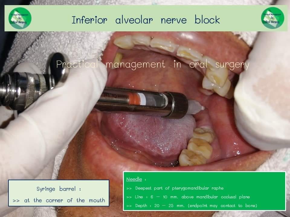 Practical - - Inferior alveolar nerve block technique - การฉีดยาชา ...
