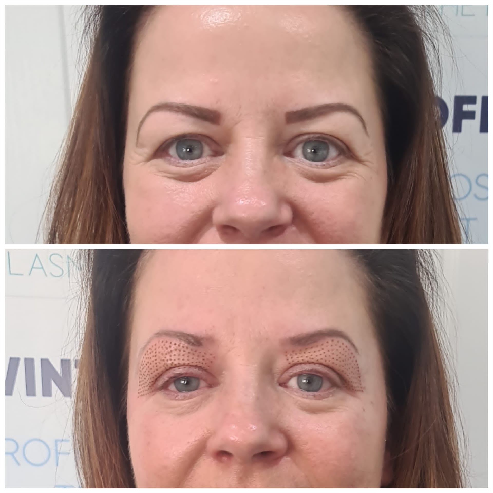 recommend a non-invasive machine for eyelid wrinkles after semaglutide.  Non-Surgical Eye Lift!  Watch this Pure Plasma Lift treatment in actiontightening droopy eyelids, reducing wrinkles, and lifting sagging skin without surgery!  No cuts, no surgery, minimal downtime! Say neuropeptides make the skin appear more relaxed Agnes RF - Non-Surgical Facial