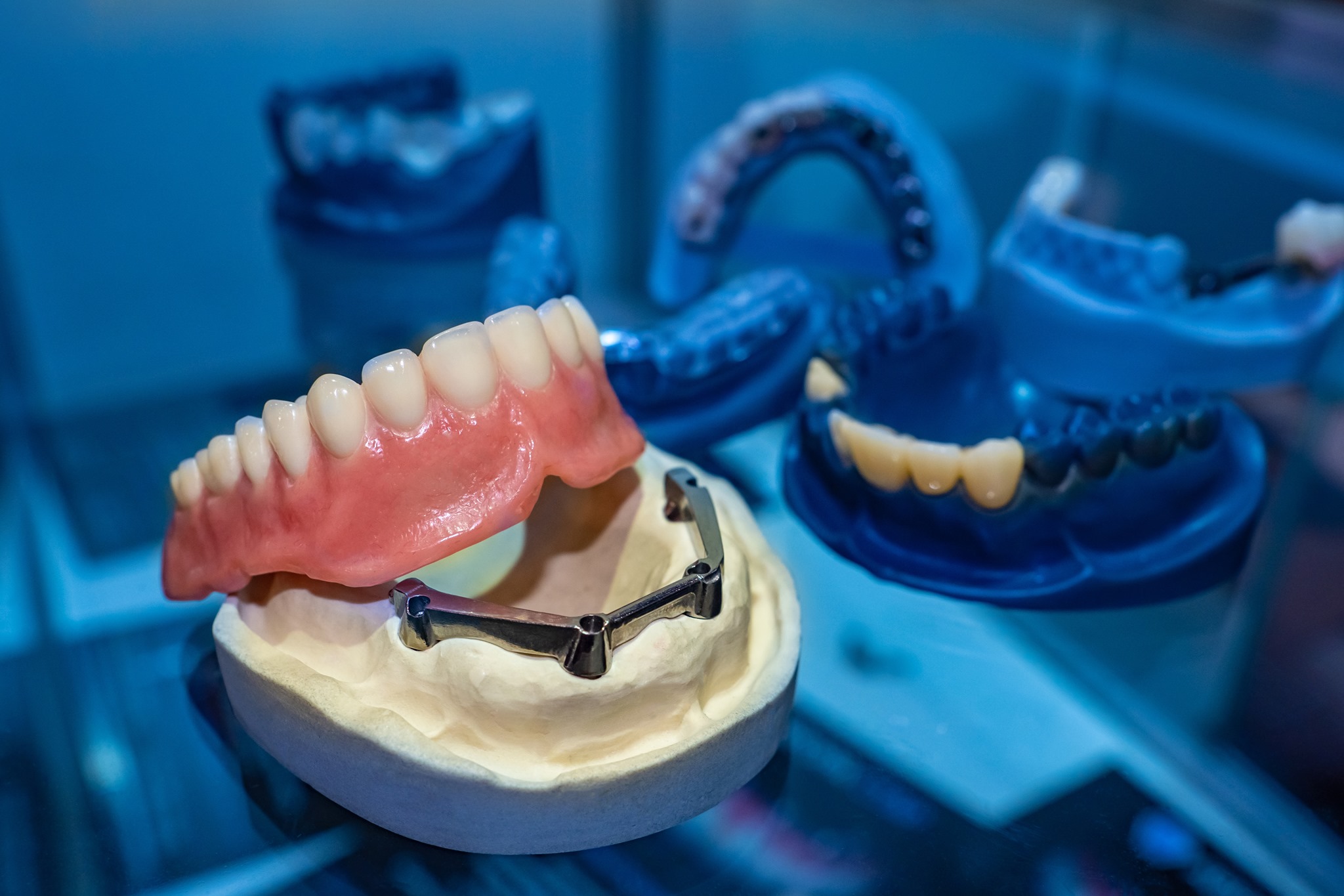 Laboratorio Dental Avila - Antes y después, colocación de prótesis ...