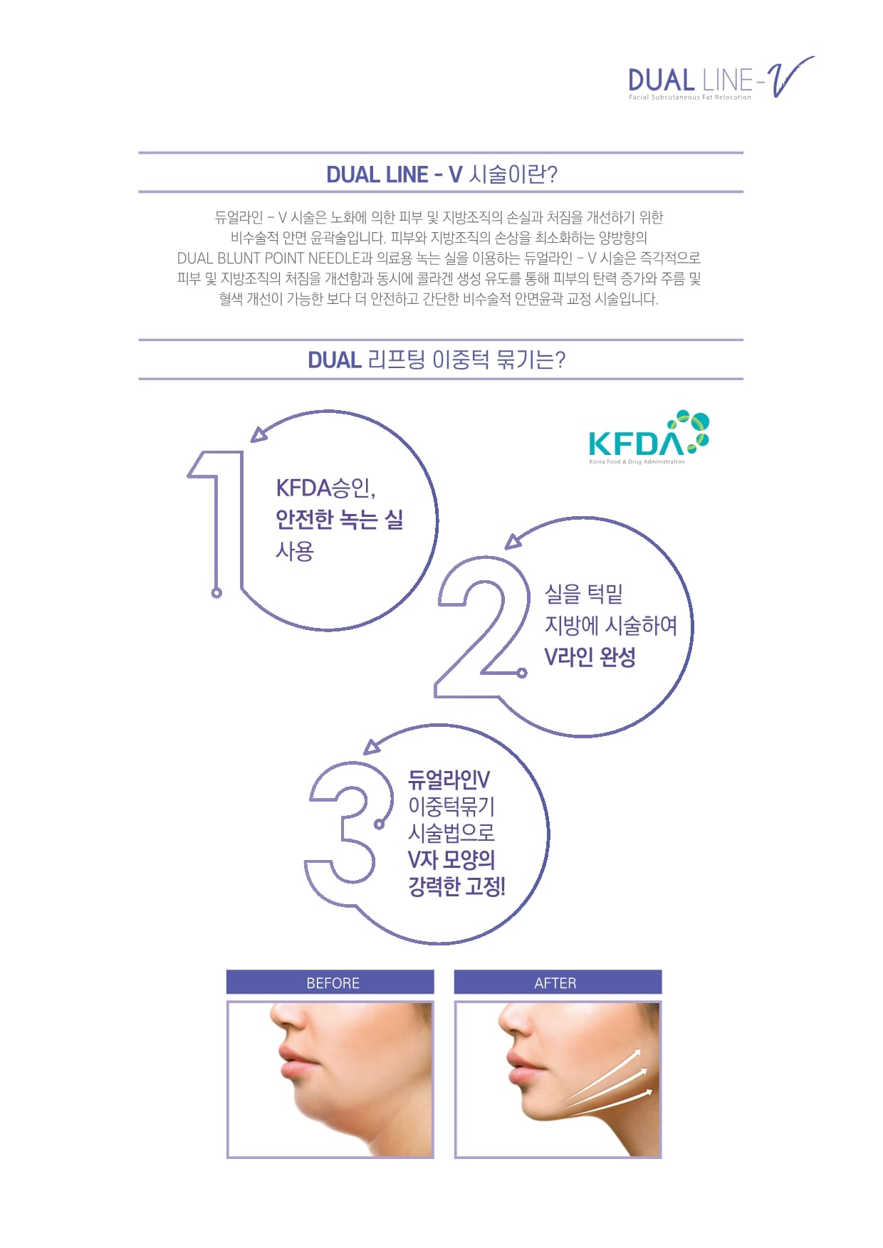 듀얼라인-브이 Dualline-V 실리프팅 added a... - 듀얼라인-브이 Dualline-V 실리프팅