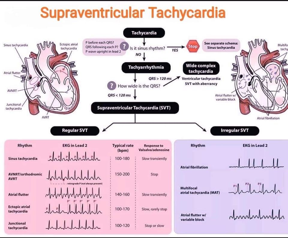 House - #ECG #Supraventriculartachycardia ***Supraventricular ...
