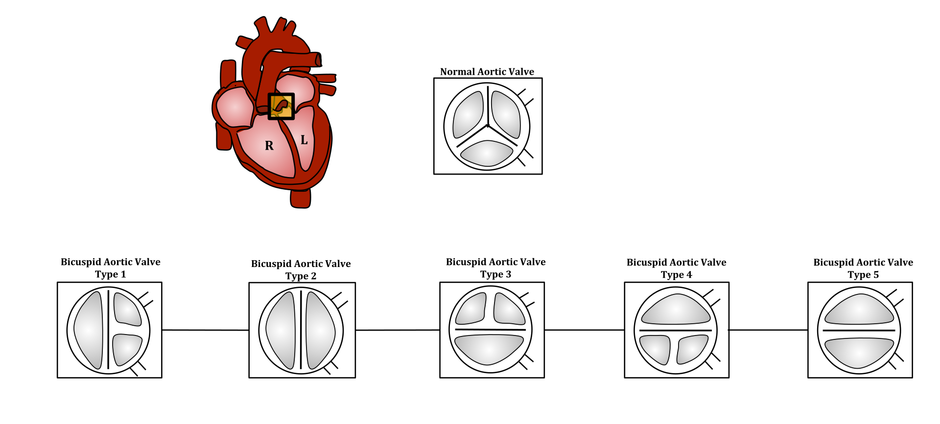 Colin's Heart Valve Replacement Journey