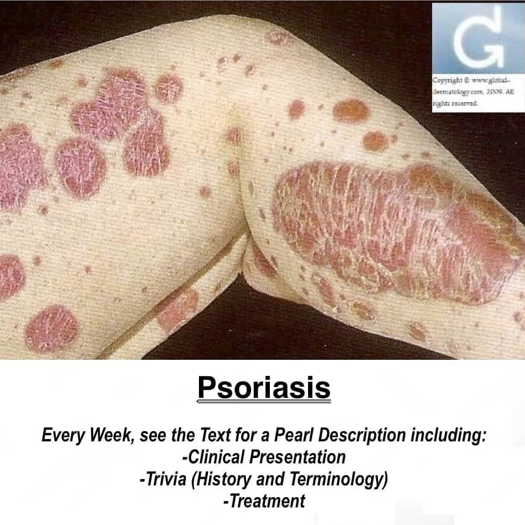 Galleria Dermatologica - Psoriasis: -Psoriasis is a common skin ...