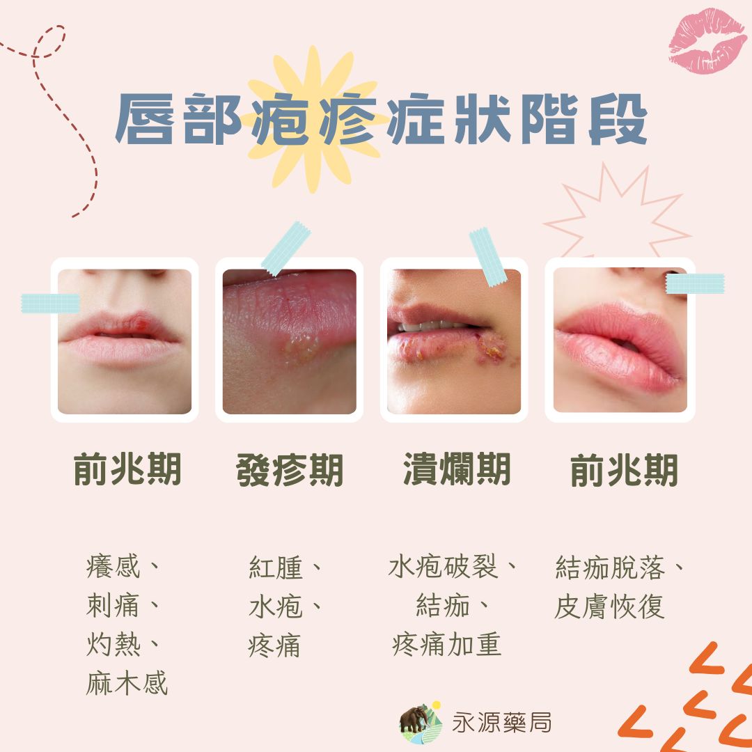 永源藥局 - 唇部疱疹是由單純疱疹病毒（HSV-1）引起的常見感染，其症狀通常包括以下幾個階段： 前兆期... | Facebook