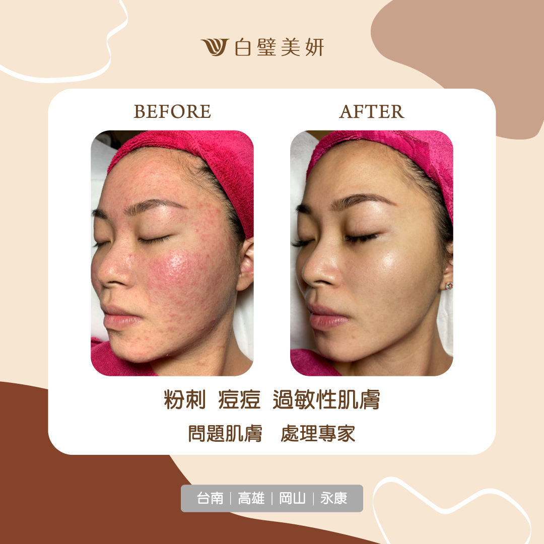 白璧美妍肌膚管理中心 - #素人案例分享 困擾很久的痘痘、過敏性肌膚 沒想到可以這麼明顯改善! 專業美容師手技，... | Facebook