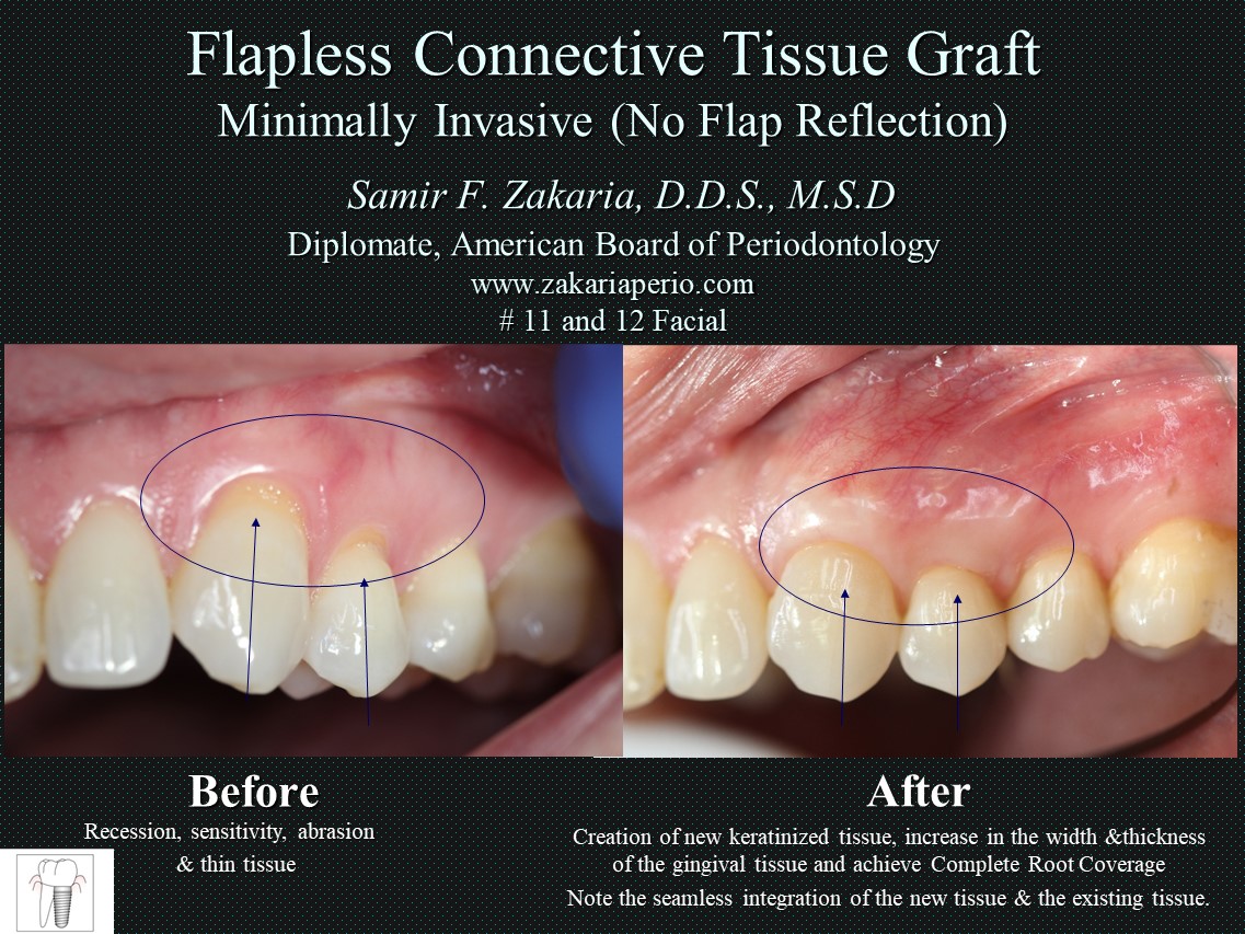 🔹 Flapless Connective... - Samir F. Zakaria, D.D.S, M.S.D. | Facebook
