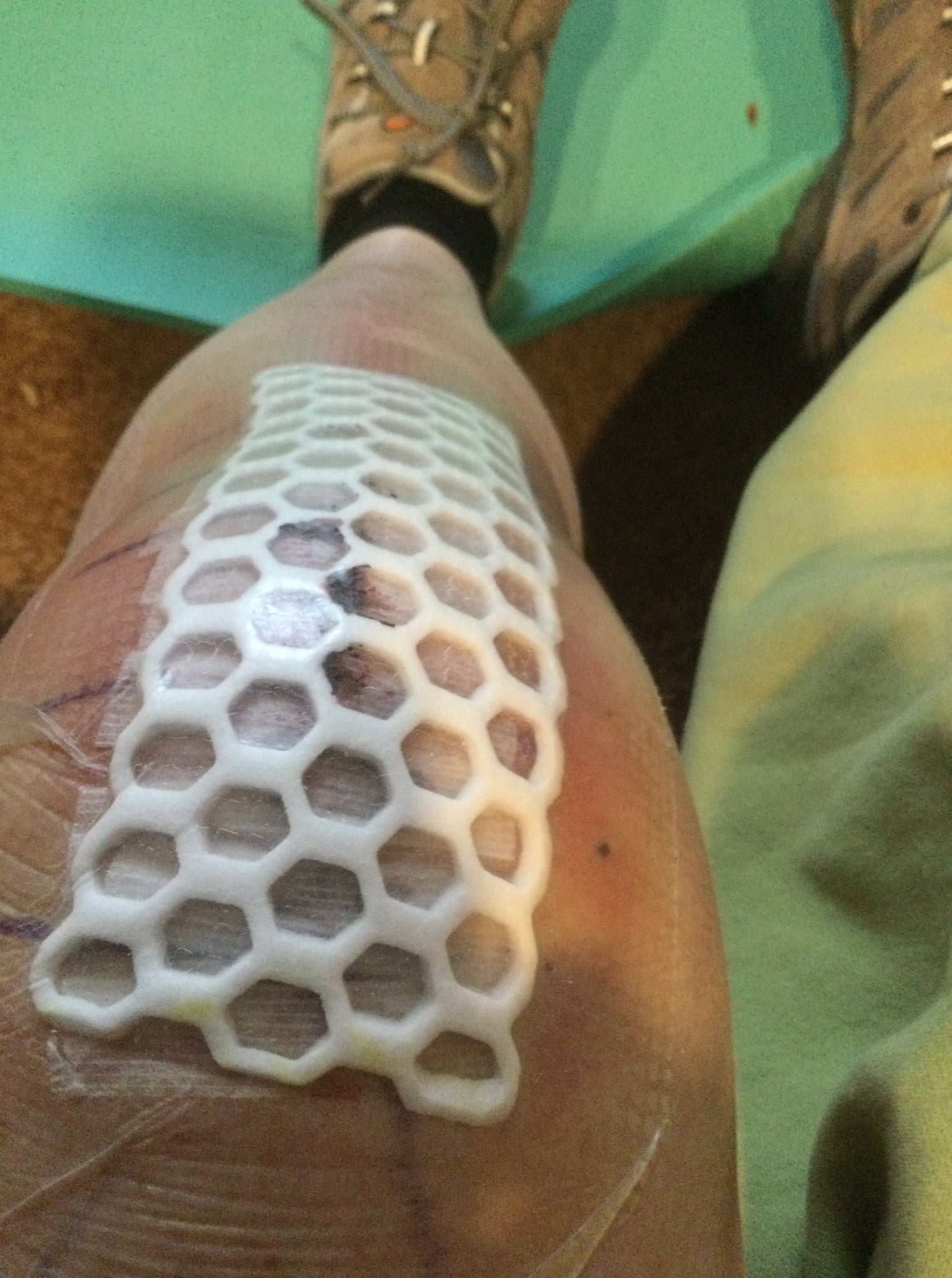 Honeycomb device over incision at PO2